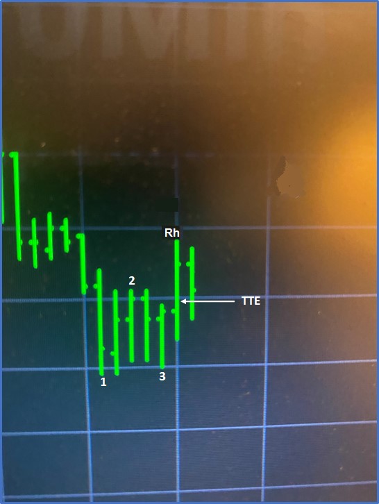 Joe Ross shares trading success with Traders Trick Entry and Ross Hook trading methods example trading education